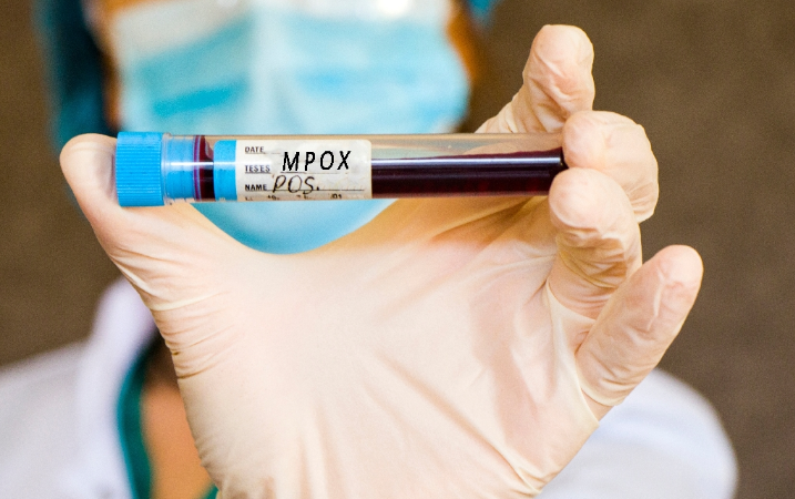 La (OMS) declaró emergencia de salud pública de importancia internacional por el brote de viruela símica (Mpox)siga estos consejos y prevenga la aparición de la viruela símica.