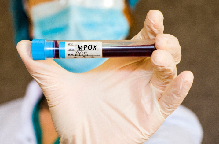 La (OMS) declaró emergencia de salud pública de importancia internacional por el brote de viruela símica (Mpox)siga estos consejos y prevenga la aparición de la viruela símica.